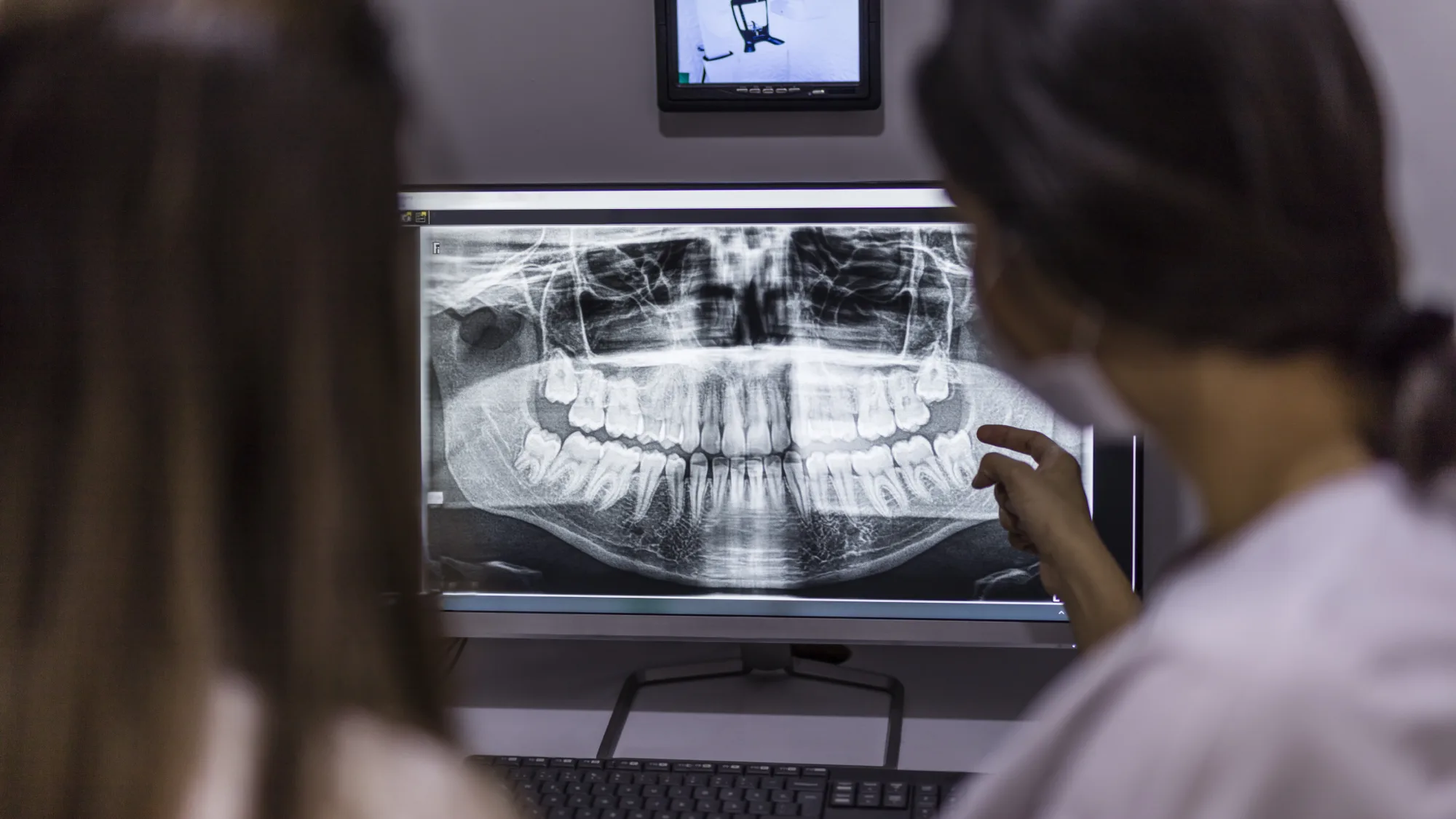 TX orasurg of frisco wisdom tooth extraction